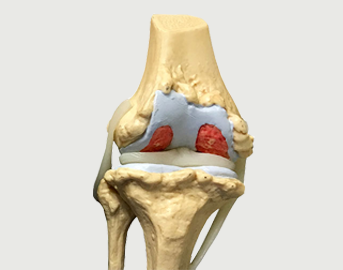 Advanced stage of arthrosis